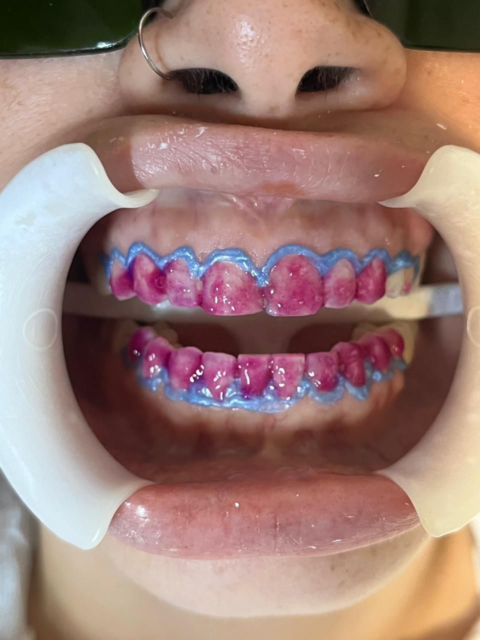 Dentes com barreira gengival e gel clareador aplicado durante sessão de clareamento